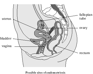 endometriosis